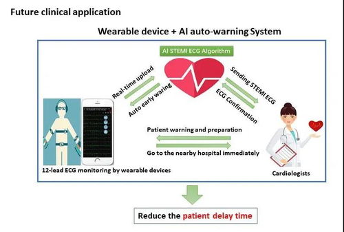 人工智能护航心脏健康 附属十院徐亚伟团队研发全球首个心肌梗死人工智能预警系统